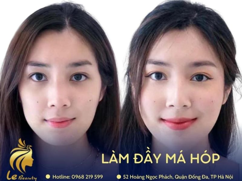 Làm đầy má hóp bằng Hyaluronic acid (chất tự thân)